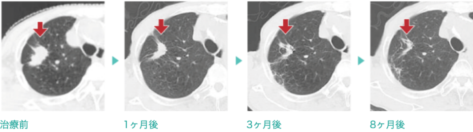 治療前→1ヶ月後→3ヶ月後→8ヶ月後